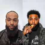 The Science Behind Afro Hair Transplant Success